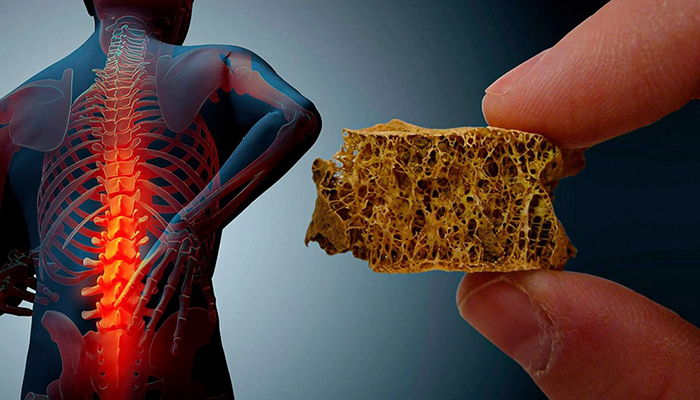 بهبود بافت استخوان توسط پژوهشگر ایرانی