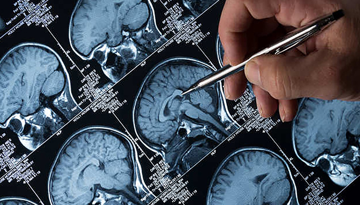 تشخیص زودهنگام بیماری آلزایمر با استفاده از بازیهای ویدئویی
