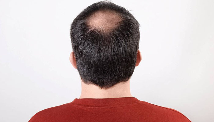 آیا کلاه گذاشتن باعث ریزش موی مردان میشود؟