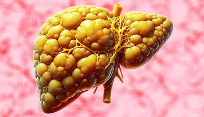 سیروز کبدی چیست؟ شناخت، پیشگیری و مدیریت این بیماری جدی و پیش‌رونده کبد