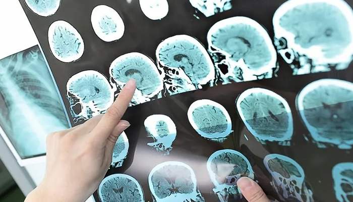 علائم و نشانههای رایج و کلیدی مه مغزی که باید بشناسید