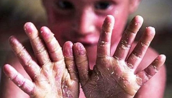 علت اصلی بیماری ای بی چیست؟