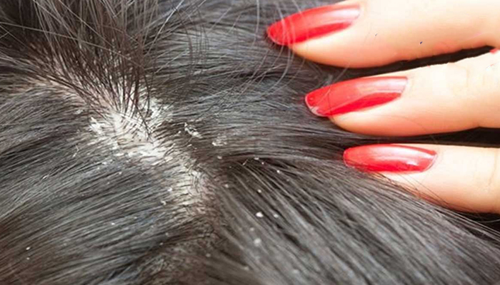 از بین بردن شپش سر با درمانهای دارویی و شامپوهای تخصصی