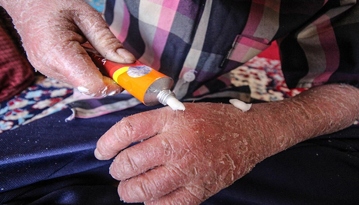 «خانه ای بی» (EB Home): نهادی برای حمایت از کودکان پروانهای در ایران