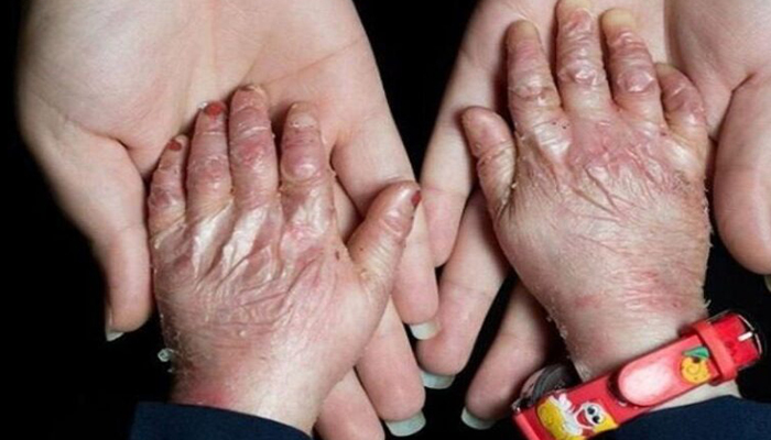 مدیریت و درمان بیماری ای بی