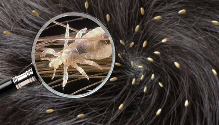 راهنمای جامع از بین بردن شپش سر: خداحافظی همیشگی با خارش و رشکها با روشهای تضمینی