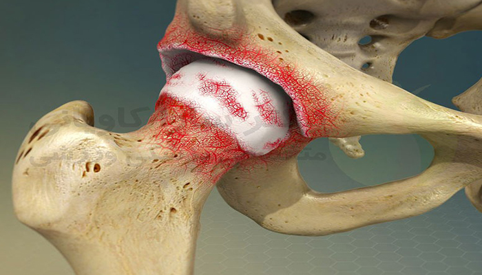 آرتروز مفاصل چیست؟ شناخت، پیشگیری و مدیریت استئوآرتریت برای بازگشت به زندگی فعال