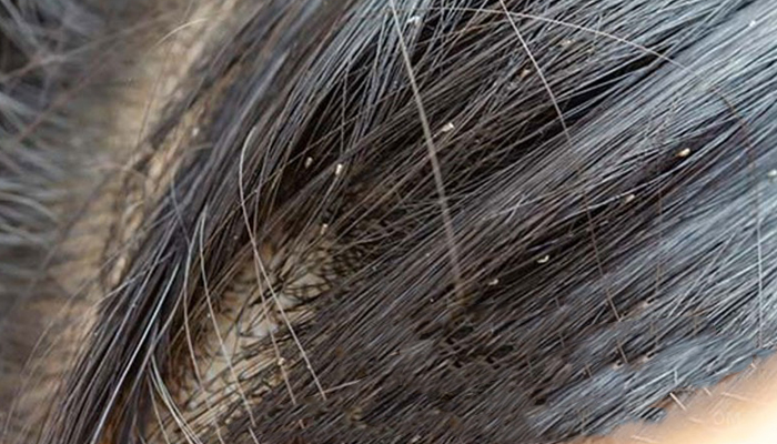 از بین بردن شپش سر