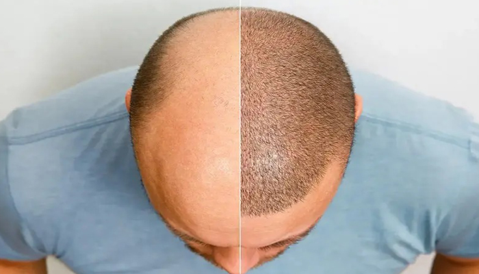 بهترین سن برای انجام کاشت مو چه زمانی است؟