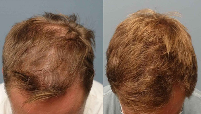 روشهای مختلف کاشت مو: جنگ واژهها یا تفاوت واقعی؟