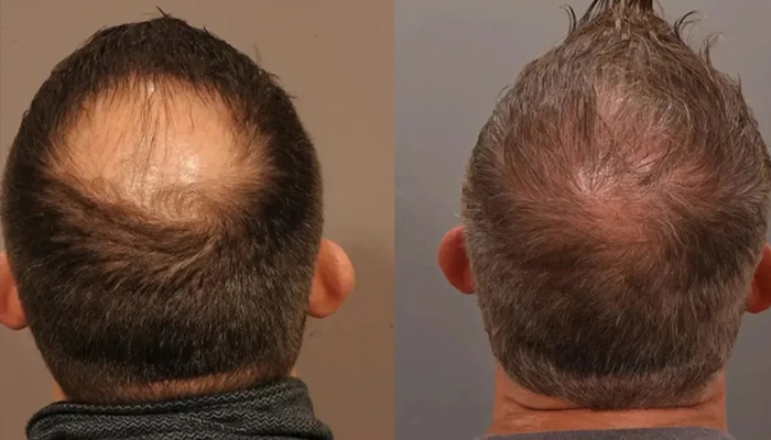 آیا کاشت مو واقعا راه حل نهایی است؟ از باورهای غلط تا واقعیت علمی