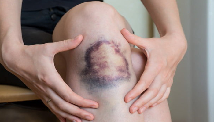 5 مورد از علائم پنهان بیماری که زنگ خطر مرگ هستند؛ از خمیازه تا کبودی + راهنما