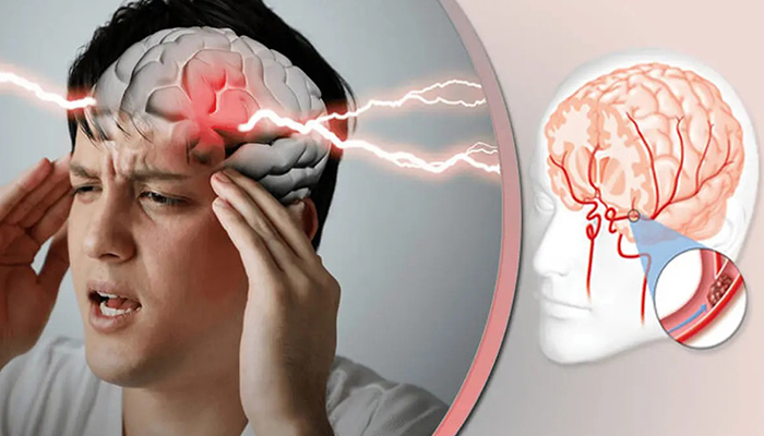 تفاوت سکته پنهان با حمله ایسکمیک گذرا (TIA)