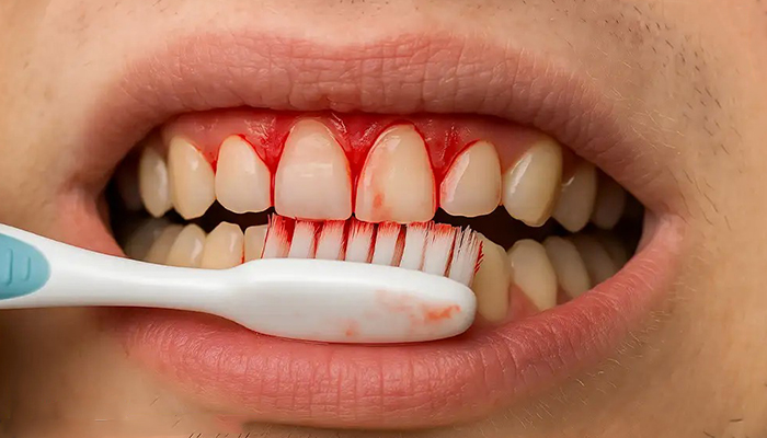 خونریزی لثه هنگام مسواک زدن؛ پاسخی صریح به یک نگرانی رایج