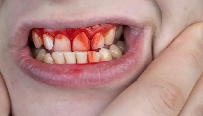 آیا سیگار کشیدن باعث خونریزی لثه میشود؟